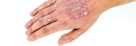 Psoriasis Treatments What Can Cause It And Can You Prevent It