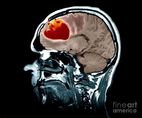 Brain Tumour Photograph By Zephyr Science Photo Library Fine Art America