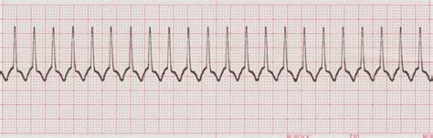 EKG Practice Drill