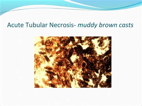 Acute And Chronic Renal Failure A Review Ppt