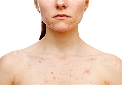 Cystic Acne Facts Causes Prevention And Treatments Consumer