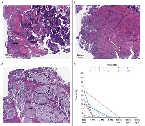 Pd Blockade In Mismatch Repairdeficient Locally Advanced Rectal