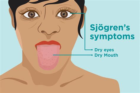 Sjögrens Syndrome Cyprus Derma Clinic