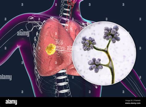 Lung Mucormycosis Lesion Illustration Stock Photo Alamy