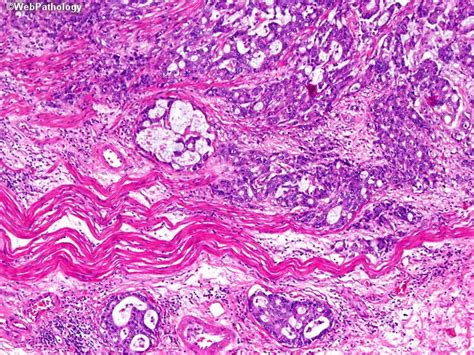 Adenocarcinoma in Barrett Esophagus