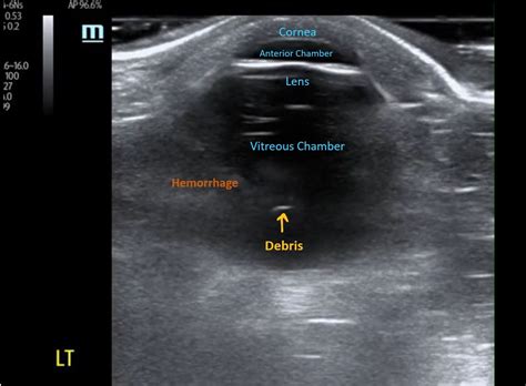 Annotated Vit Hemorrhage Figure 3 Aliem