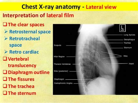 Anatomy Of Chest X Ray : Normal chest x-ray | Radiology Case ...