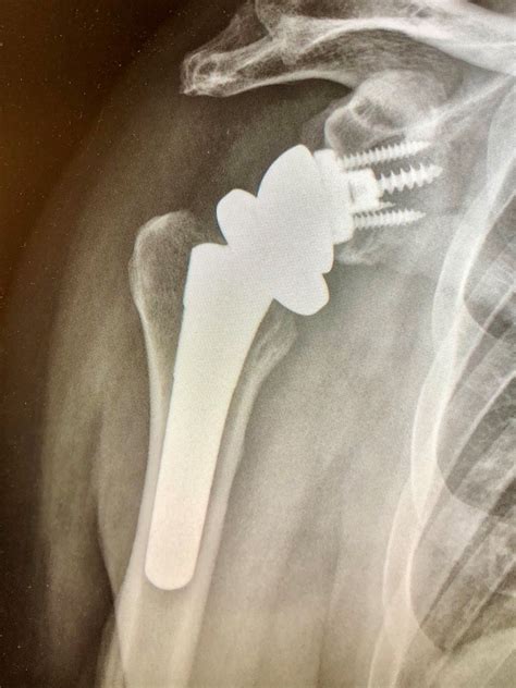Rotator Cuff Tear Arthropathy Shoulder Arthritis Shoulder Surgeon