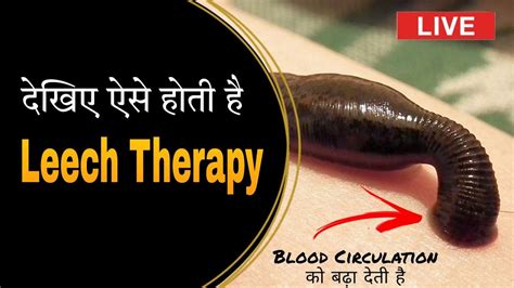 Leech Therapy Jaluka जलौका Hair Fall Treatment Jaluka Ayurvedic