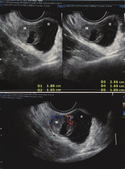 Transvaginal Doppler Ultrasound Showing A 19 Â 17 Mm Mass With A Yolk