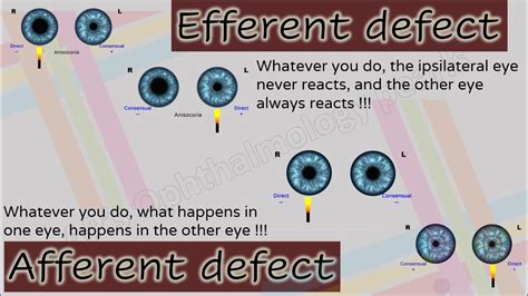 Pupil 2 Characteristics Of Afferent And Efferent Pupillary Defects