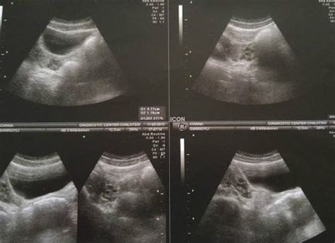 Descobri Aos Anos Que Nasci Sem Vagina