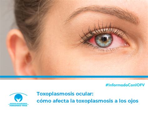 Toxoplasmosis Ocular Cómo Afecta La Toxoplasmosis A Los Ojos