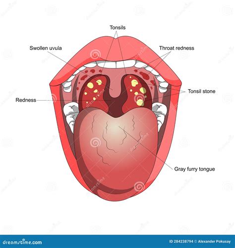 Tonsillitis Diagram Medical Science Royalty Free Illustration