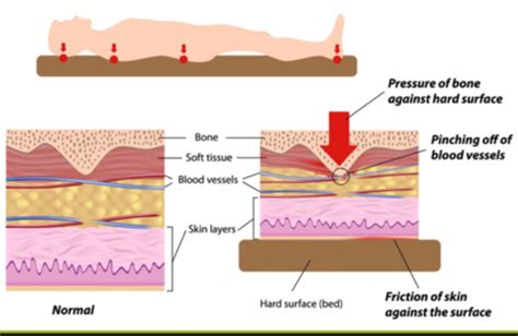 Patient Draping And Positioning Flashcards Quizlet