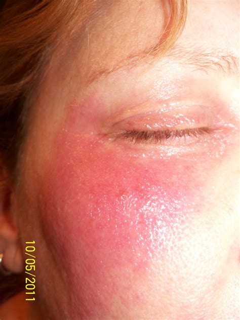 My Really, Real Reality: The Saga of the Rash Continues