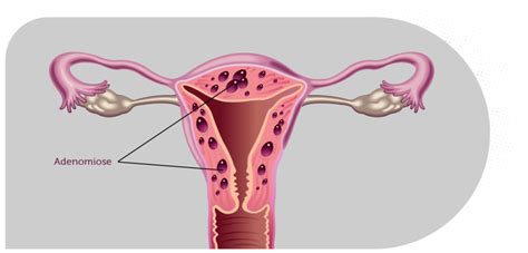 Adenomiose E Endometriose Conhe A As Diferen As Elo Medicina Reprodutiva