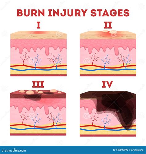 Skin Burn Injury Treatment First Aid For Burn Wound Vector