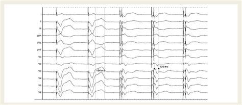 Example of QRS complex measurement using calibrators prior to and ...