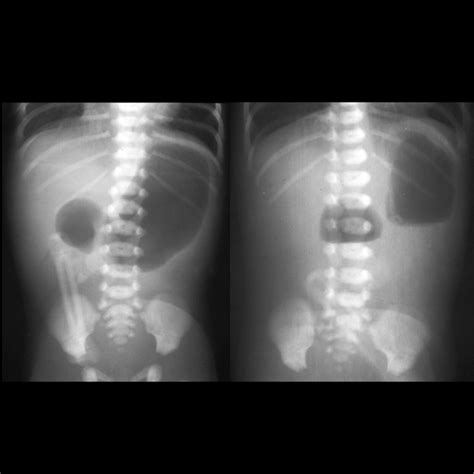 Duodenal Atresia Pediatric Radiology Reference Article Pediatric