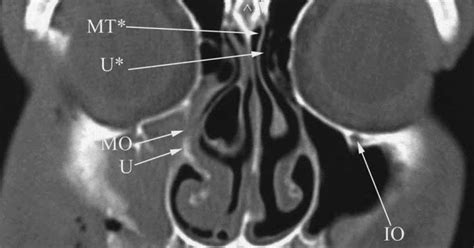Radiology Anatomy Images Ct Pns Anatomy