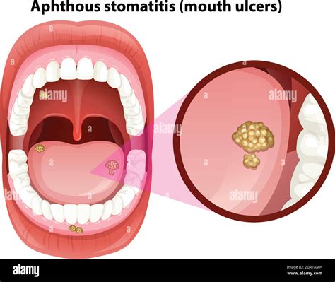 Canker Sore Diagram