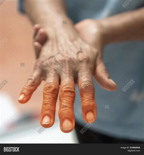 Peripheral Neuropathy Image & Photo (Free Trial) | Bigstock