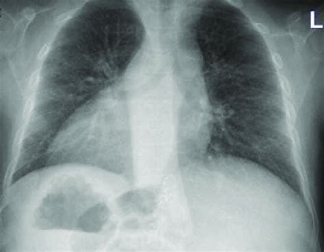 Preoperative Chest Radiograph Showing Dextrocardia And Chronic