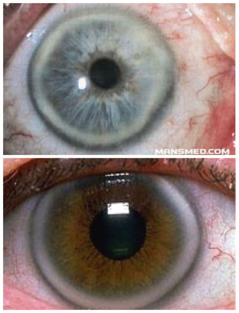 What's That Ring Around My Eye?