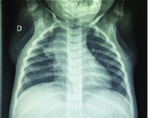 Chest X Ray Showing Tuberculosis