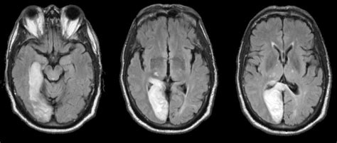 Posterior Cerebral Artery Mri