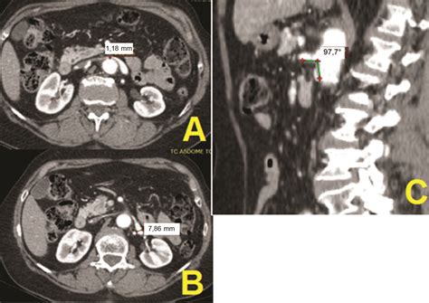 Scielo Brasil Compress Es Das Veias Renal E Il Aca Comum Esquerdas