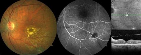 Retinal Arterial Macroaneurysm Retinara