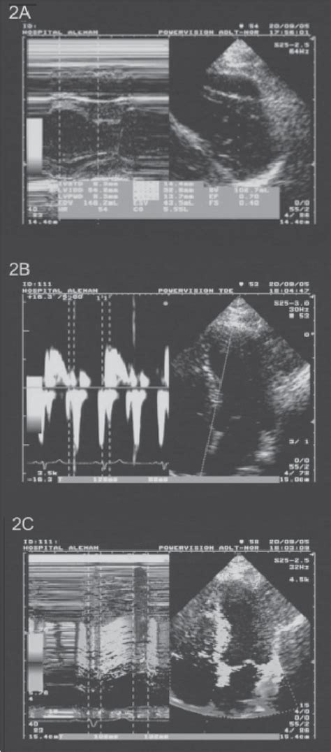 Figure 1 From Primary Hemochromatosis Early Detection Of Myocardial