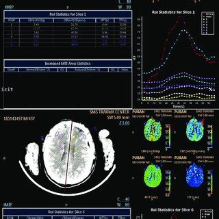 Upper Part Of Figure Is Preoperative Computed Tomography Perfusion