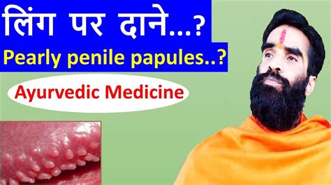 Pearly Penile Papules Gharelu Upay Ling Par Dane Ayurvedic Medicine Youtube