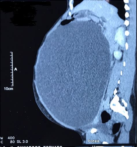Click image for larger versionName:Ovarian_cyst_xray.jpegViews:46Size:1 ...