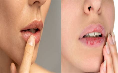 Dry Lips In Summer Tips To Get Rid Of Chapped Lips In Summer Bml Dry Lips In Summer गर्मियों