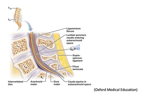 Ultrasound Guided Lumbar Puncture Core Em