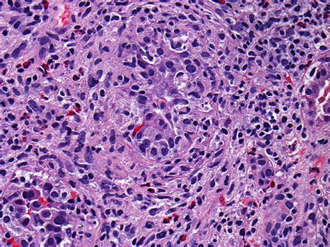 An atypical form of renal failure: granulomatous interstitial nephritis ...