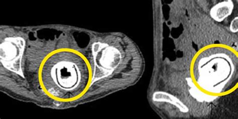 Mulher esquece objeto na vagina por dez anos e coloca saúde em risco por que deixamos de ir ao