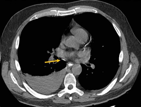 CT Esophagography For Evaluation Of Esophageal Perforation RadioGraphics