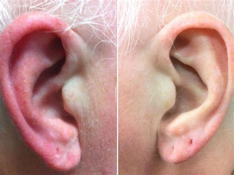 Red Ears Symptoms Causes And Treatment