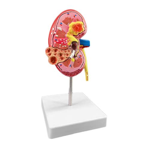 Lbylyh Kidney Stones Disease Model Urology Kidney Nephron Renal