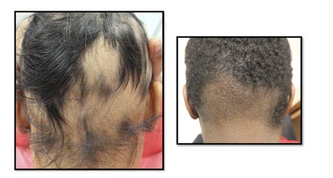 Comparing Ophiasis Alopecia Areata To Occipital Frontal Fibrosing