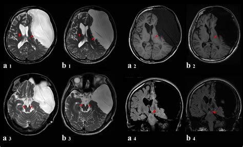 Arachnoid Cyst