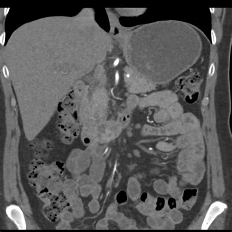 Normal Ct Renal Artery Angiogram Image