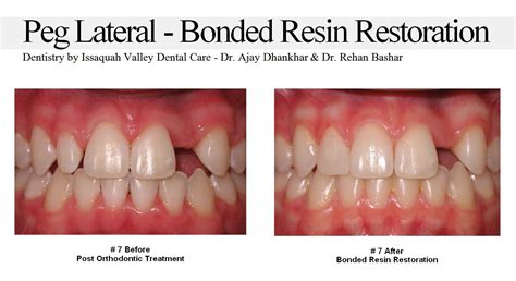 Peg Lateral Bonded Resin Restoration Orthodontic Treatment Dental