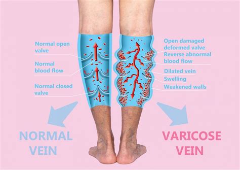 vein treatments vein specialists   carolinas treat thousands yearly