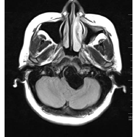 A T1W Sagittal B FLAIR Transverse And C Postcontrast T1W